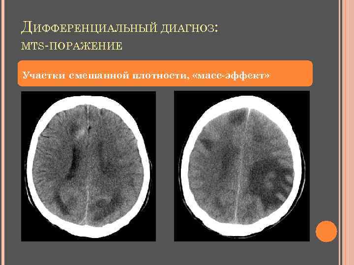 ДИФФЕРЕНЦИАЛЬНЫЙ ДИАГНОЗ: MTS-ПОРАЖЕНИЕ Участки смешанной плотности, «масс-эффект» 