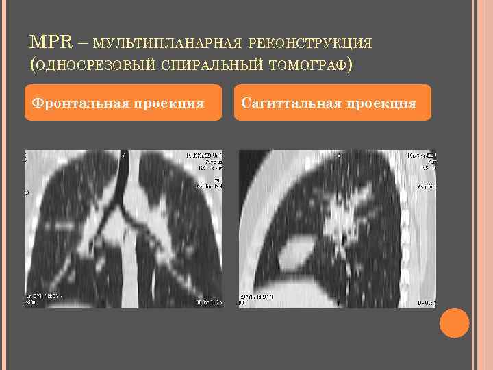 MPR – МУЛЬТИПЛАНАРНАЯ РЕКОНСТРУКЦИЯ (ОДНОСРЕЗОВЫЙ СПИРАЛЬНЫЙ ТОМОГРАФ) Фронтальная проекция Сагиттальная проекция 