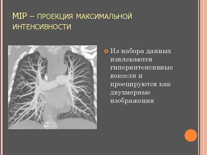 Максимальная проекция. Проекция максимальной интенсивности кт. Проекция максимальной интенсивности mip. Реконструкция проекций максимальной интенсивности – это.