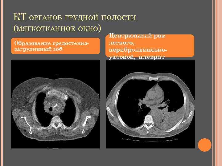 КТ ОРГАНОВ ГРУДНОЙ ПОЛОСТИ (МЯГКОТКАННОЕ ОКНО) Образование средостениязагрудинный зоб Центральный рак легкого, перибронхиальноузловой, плеврит