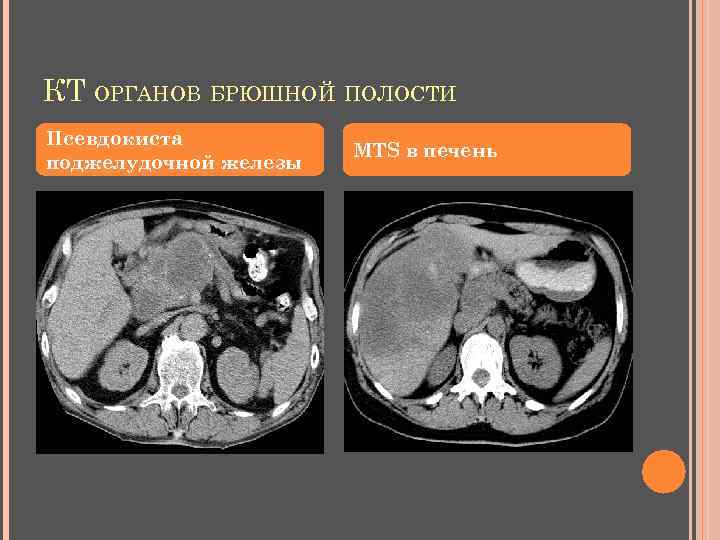 КТ ОРГАНОВ БРЮШНОЙ ПОЛОСТИ Псевдокиста поджелудочной железы MTS в печень 