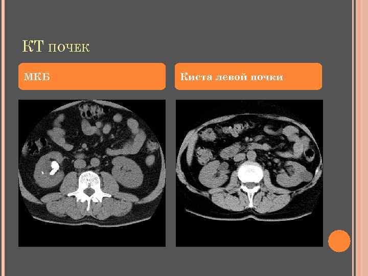 КТ ПОЧЕК МКБ Киста левой почки 