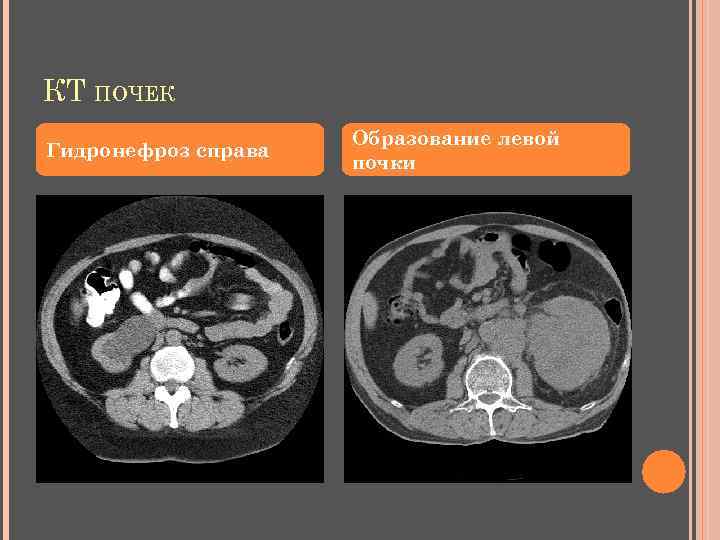 КТ ПОЧЕК Гидронефроз справа Образование левой почки 