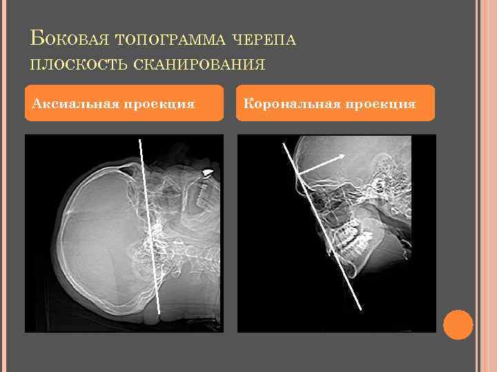 БОКОВАЯ ТОПОГРАММА ЧЕРЕПА ПЛОСКОСТЬ СКАНИРОВАНИЯ Аксиальная проекция Корональная проекция 