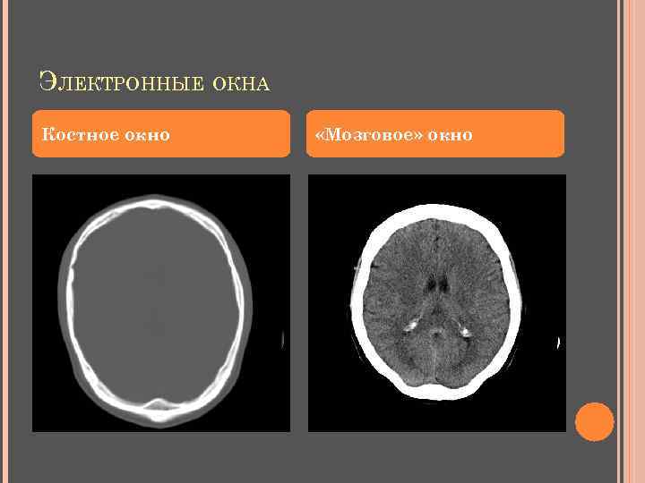 ЭЛЕКТРОННЫЕ ОКНА Костное окно «Мозговое» окно 