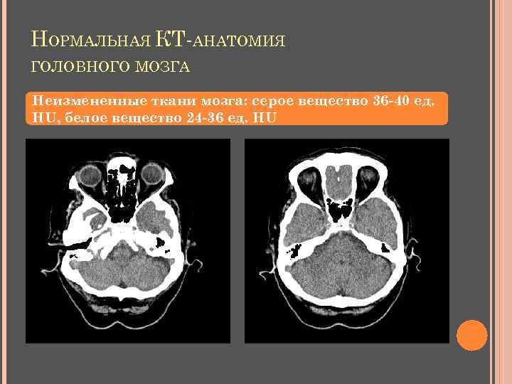 НОРМАЛЬНАЯ КТ-АНАТОМИЯ ГОЛОВНОГО МОЗГА Неизмененные ткани мозга: серое вещество 36 -40 ед. НU, белое