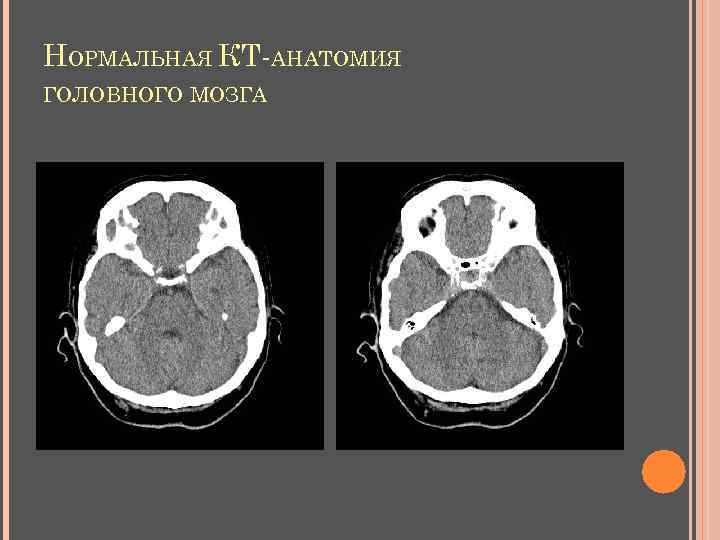 НОРМАЛЬНАЯ КТ-АНАТОМИЯ ГОЛОВНОГО МОЗГА 