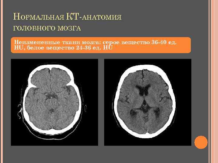 НОРМАЛЬНАЯ КТ-АНАТОМИЯ ГОЛОВНОГО МОЗГА Неизмененные ткани мозга: серое вещество 36 -40 ед. НU, белое