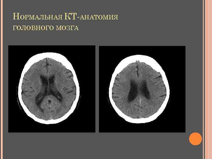 НОРМАЛЬНАЯ КТ-АНАТОМИЯ ГОЛОВНОГО МОЗГА 