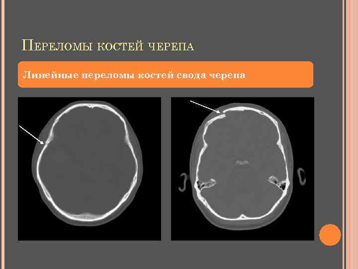 ПЕРЕЛОМЫ КОСТЕЙ ЧЕРЕПА Линейные переломы костей свода черепа 