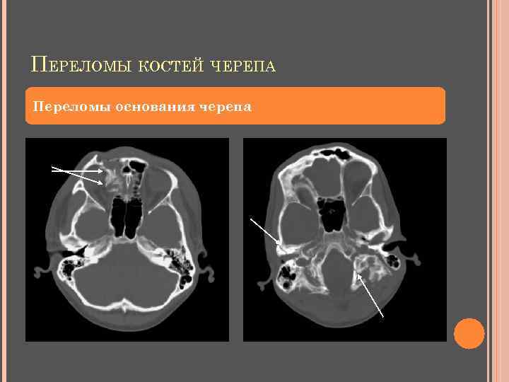 ПЕРЕЛОМЫ КОСТЕЙ ЧЕРЕПА Переломы основания черепа 