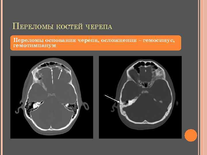 ПЕРЕЛОМЫ КОСТЕЙ ЧЕРЕПА Переломы основания черепа, осложнения – гемосинус, гемотимпанум 