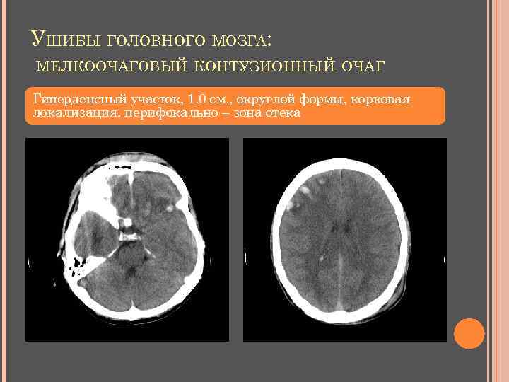 УШИБЫ ГОЛОВНОГО МОЗГА: МЕЛКООЧАГОВЫЙ КОНТУЗИОННЫЙ ОЧАГ Гиперденсный участок, 1. 0 см. , округлой формы,
