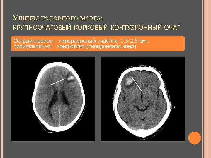 УШИБЫ ГОЛОВНОГО МОЗГА: КРУПНООЧАГОВЫЙ КОРКОВЫЙ КОНТУЗИОННЫЙ ОЧАГ Острый период – гиперденсный участок, 1. 5