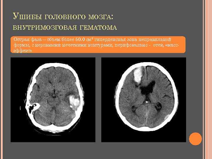 УШИБЫ ГОЛОВНОГО МОЗГА: ВНУТРИМОЗГОВАЯ ГЕМАТОМА Острая фаза – объем более 50. 0 см 3