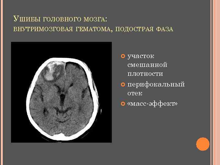 УШИБЫ ГОЛОВНОГО МОЗГА: ВНУТРИМОЗГОВАЯ ГЕМАТОМА, ПОДОСТРАЯ ФАЗА участок смешанной плотности перифокальный отек «масс-эффект» 