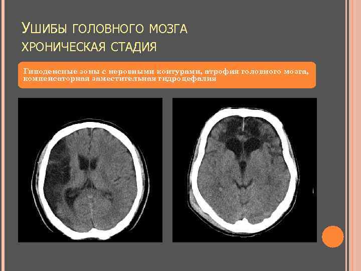 УШИБЫ ГОЛОВНОГО МОЗГА ХРОНИЧЕСКАЯ СТАДИЯ Гиподенсные зоны с неровными контурами, атрофия головного мозга, компенсаторная