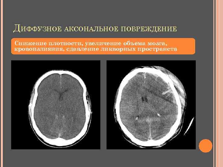 ДИФФУЗНОЕ АКСОНАЛЬНОЕ ПОВРЕЖДЕНИЕ Снижение плотности, увеличение объема мозга, кровоизлияния, сдавление ликворных пространств 