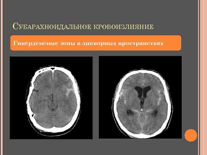 СУБАРАХНОИДАЛЬНОЕ КРОВОИЗЛИЯНИЕ Гиперденсные зоны в ликворных пространствах 