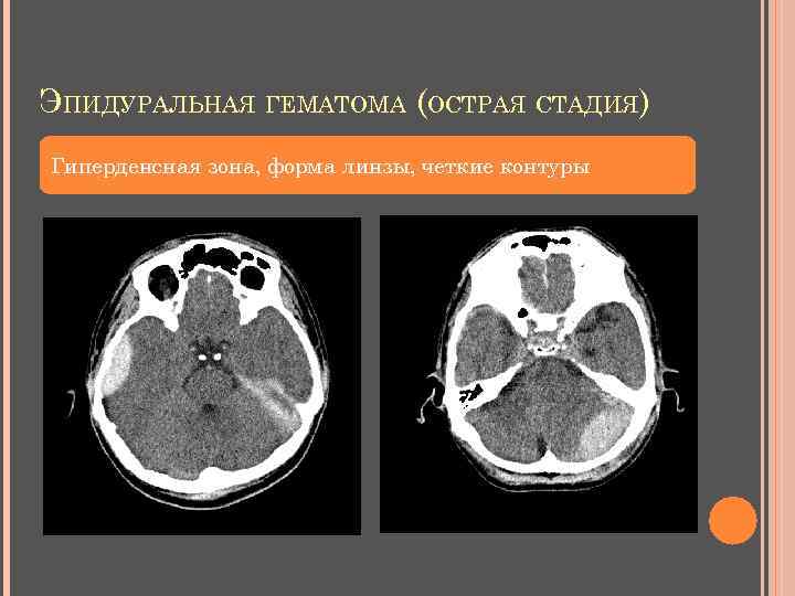 ЭПИДУРАЛЬНАЯ ГЕМАТОМА (ОСТРАЯ СТАДИЯ) Гиперденсная зона, форма линзы, четкие контуры 