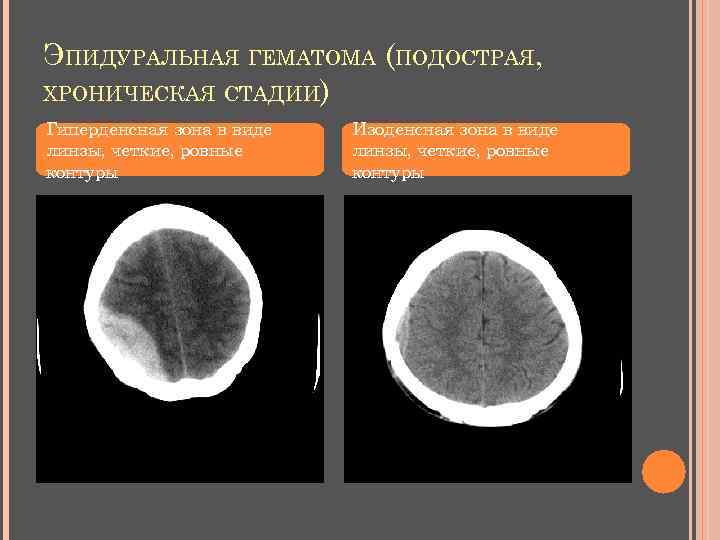 ЭПИДУРАЛЬНАЯ ГЕМАТОМА (ПОДОСТРАЯ, ХРОНИЧЕСКАЯ СТАДИИ) Гиперденсная зона в виде линзы, четкие, ровные контуры Изоденсная