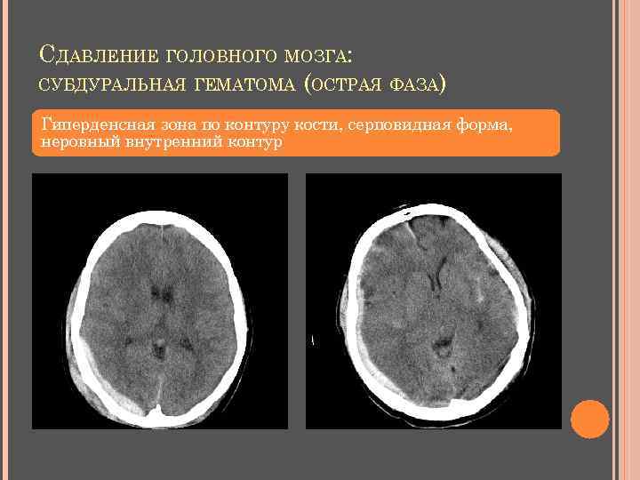 СДАВЛЕНИЕ ГОЛОВНОГО МОЗГА: СУБДУРАЛЬНАЯ ГЕМАТОМА (ОСТРАЯ ФАЗА) Гиперденсная зона по контуру кости, серповидная форма,