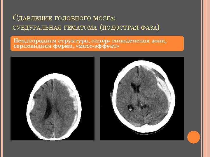 СДАВЛЕНИЕ ГОЛОВНОГО МОЗГА: СУБДУРАЛЬНАЯ ГЕМАТОМА (ПОДОСТРАЯ ФАЗА) Неоднородная структура, гипер- гиподенсная зона, серповидная форма,