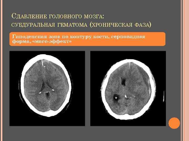 СДАВЛЕНИЕ ГОЛОВНОГО МОЗГА: СУБДУРАЛЬНАЯ ГЕМАТОМА (ХРОНИЧЕСКАЯ ФАЗА) Гиподенсная зона по контуру кости, серповидная форма,