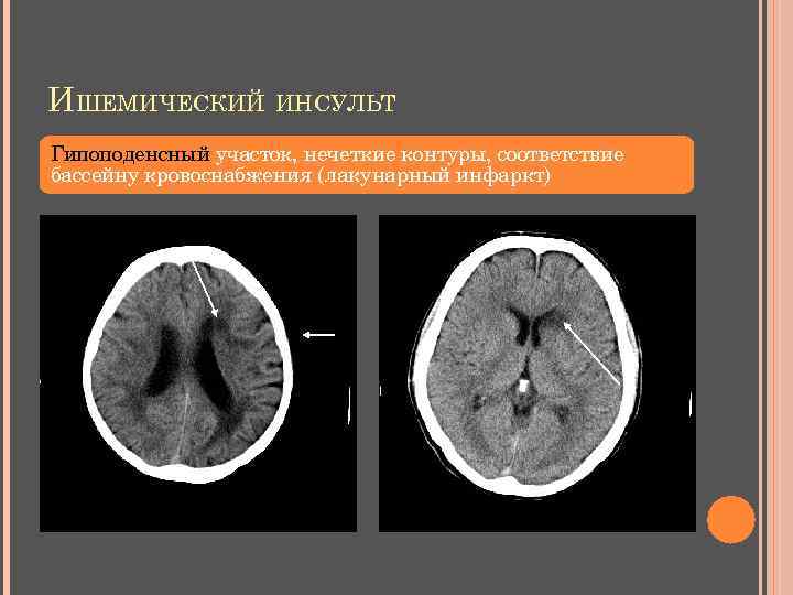 ИШЕМИЧЕСКИЙ ИНСУЛЬТ Гипоподенсный участок, нечеткие контуры, соответствие бассейну кровоснабжения (лакунарный инфаркт) 
