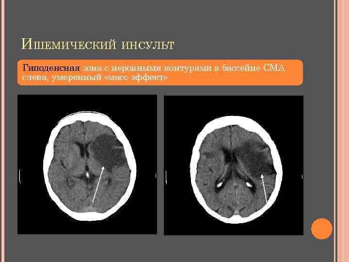 ИШЕМИЧЕСКИЙ ИНСУЛЬТ Гиподенсная зона с неровными контурами в бассейне СМА слева, умеренный «масс-эффект» 