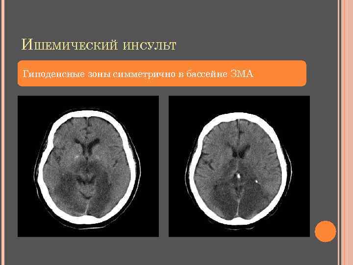ИШЕМИЧЕСКИЙ ИНСУЛЬТ Гиподенсные зоны симметрично в бассейне ЗМА 