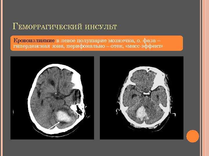 ГЕМОРРАГИЧЕСКИЙ ИНСУЛЬТ Кровоизлияние в левое полушарие мозжечка, о. фаза – гиперденсная зона, перифокально –