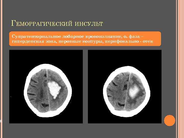 к ГЕМОРРАГИЧЕСКИЙ ИНСУЛЬТ Супратенториальное лобарное кровоизлияние, о. фаза – гиперденсная зона, неровные контуры, перифокально