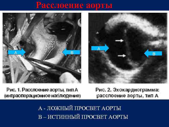 Аневризма грудной аорты фото