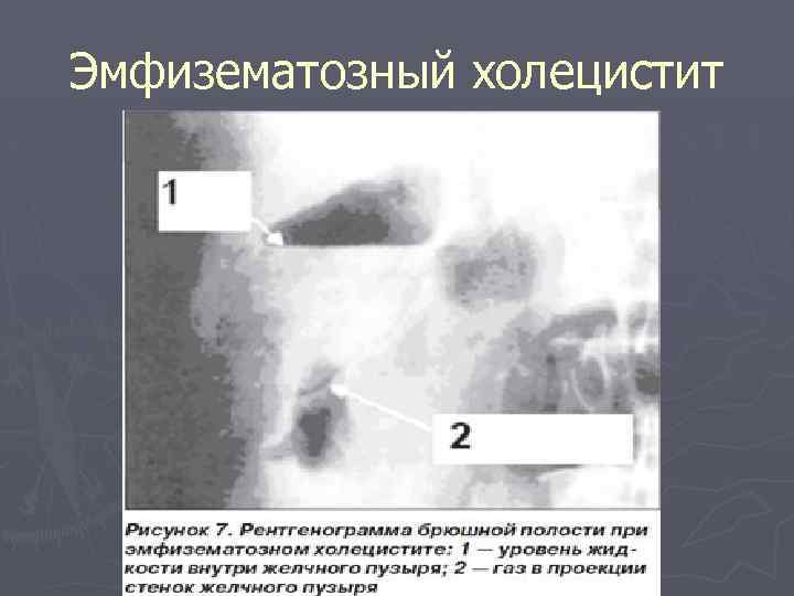 Эмфизематозный холецистит 