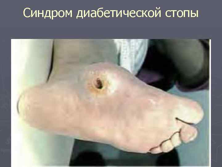 Синдром диабетической стопы 