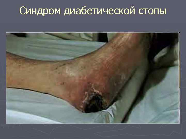 Синдром диабетической стопы 