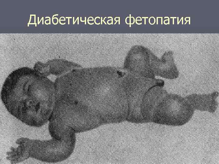 Диабетическая фетопатия 