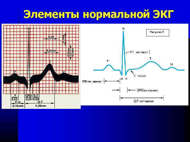 Элементы нормальной ЭКГ 
