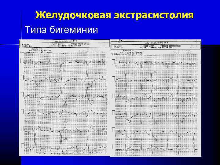 Нарушение ритма по типу бигеминии карта вызова