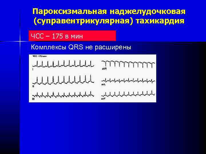 Наджелудочковые тахикардии по утвержденным клиническим рекомендациям