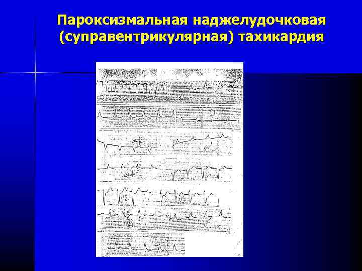 Пароксизмальная наджелудочковая (суправентрикулярная) тахикардия 