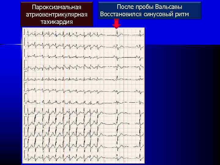 Пароксизмальная атриовентрикулярная тахикардия После пробы Вальсавы Восстановился синусовый ритм 