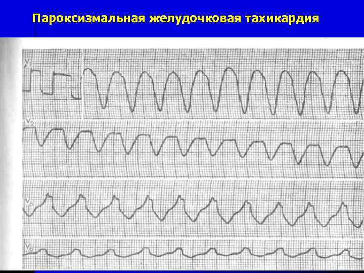 Пароксизмальная желудочковая тахикардия 