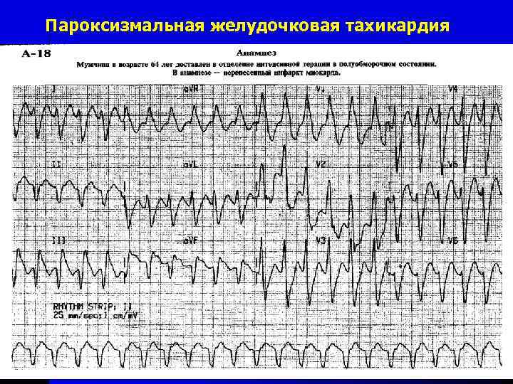 Аритмия карта вызова