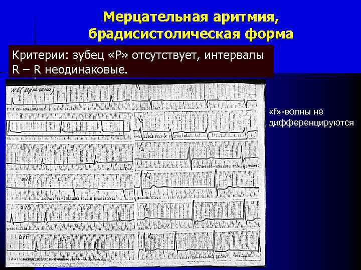 Мерцательная аритмия, брадисистолическая форма Критерии: зубец «Р» отсутствует, интервалы R – R неодинаковые. «f»