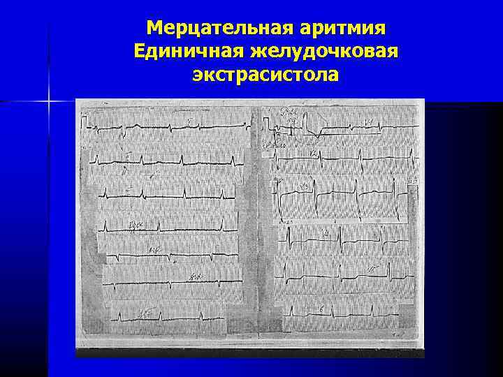 Мерцательная аритмия Единичная желудочковая экстрасистола 