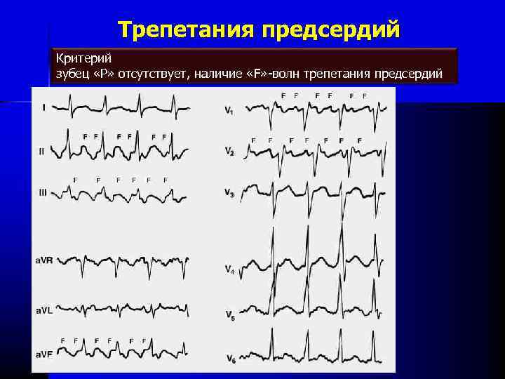 Трепетание предсердий на экг