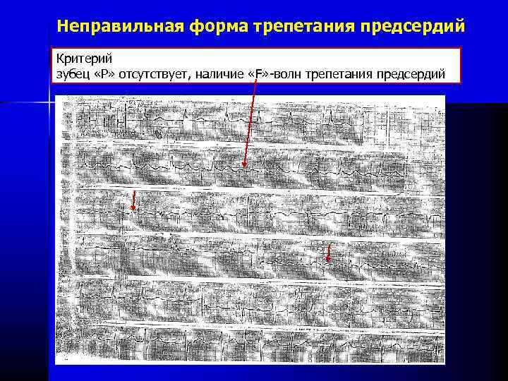 Неправильная форма трепетания предсердий Критерий зубец «Р» отсутствует, наличие «F» волн трепетания предсердий 