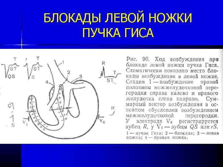 Внутрижелудочковая проводимость. Внутрижелудочковая блокада. Блокада левой ножки пучка Гиса.. Внутрижелудочковая блокада левой ножки. Внутрижелудочковая блокада левой ножки пучка Гиса ЭКГ. Внутрижелудочковая блокада левой ножки пучка Гиса.